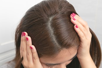 Seborrheic Dermatitis