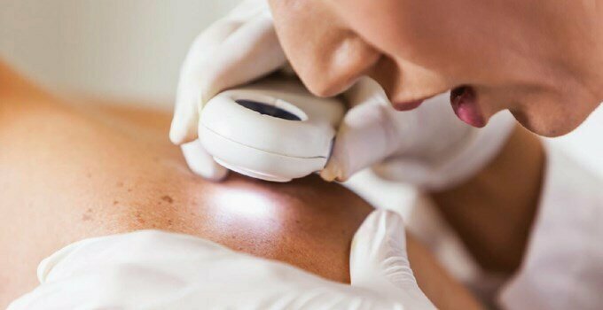 melanoma