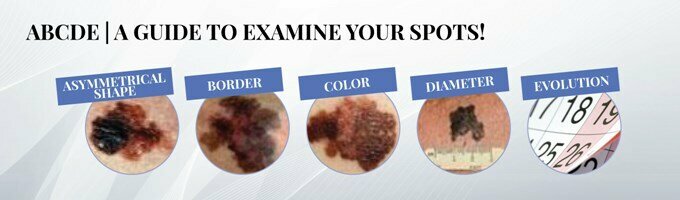 melanoma
