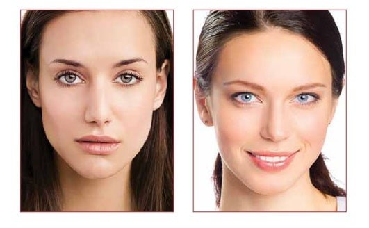 Fillerina®, the Non-Invasive Hyaluronic Acid Filler! - SweetCare