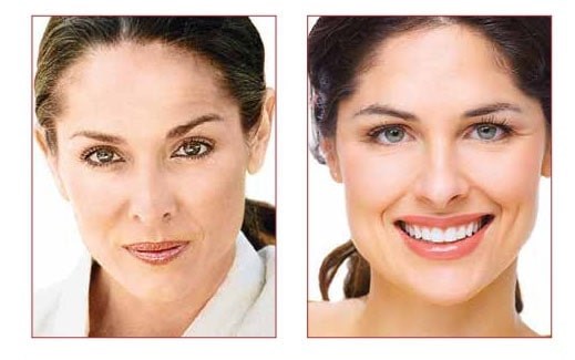 Fillerina®, the Non-Invasive Hyaluronic Acid Filler! - SweetCare
