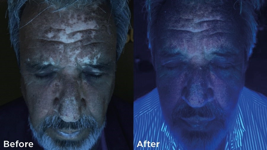 REPIGMENT RESULTS