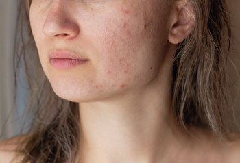 Acne in Adolescence