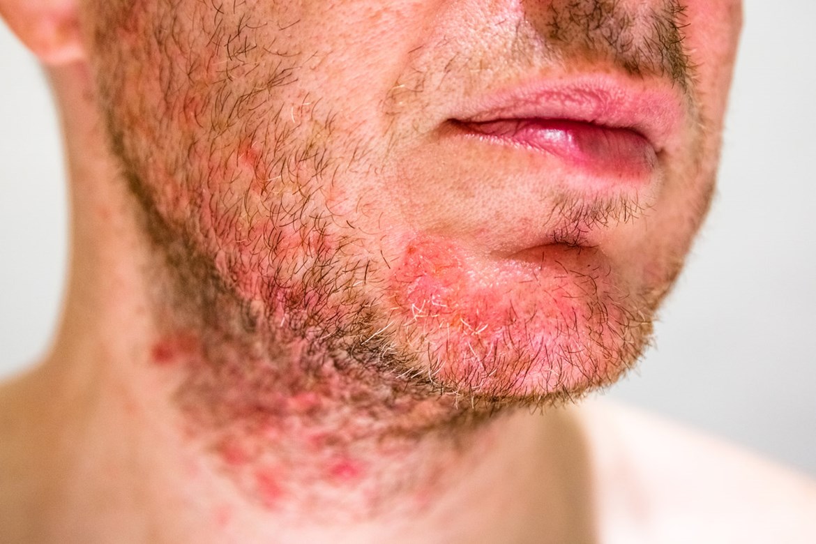 Seborrheic Dermatitis