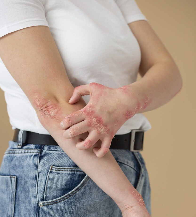 Para Além da Pele: Eczema e o Impacto na Vida Diária