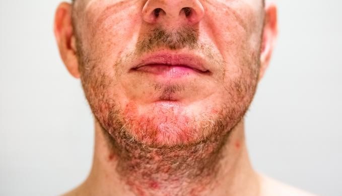 Seborrheic Dermatitis