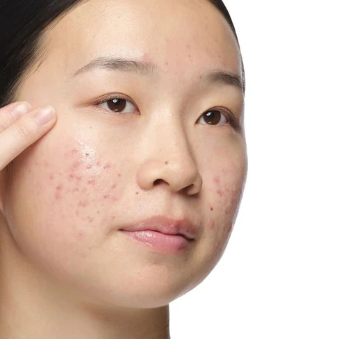 Aloe 2% + Nag 2% Solution Blemish-Prone Skin - The Ordinary | Buy at  Sweetcare - SweetCare United States