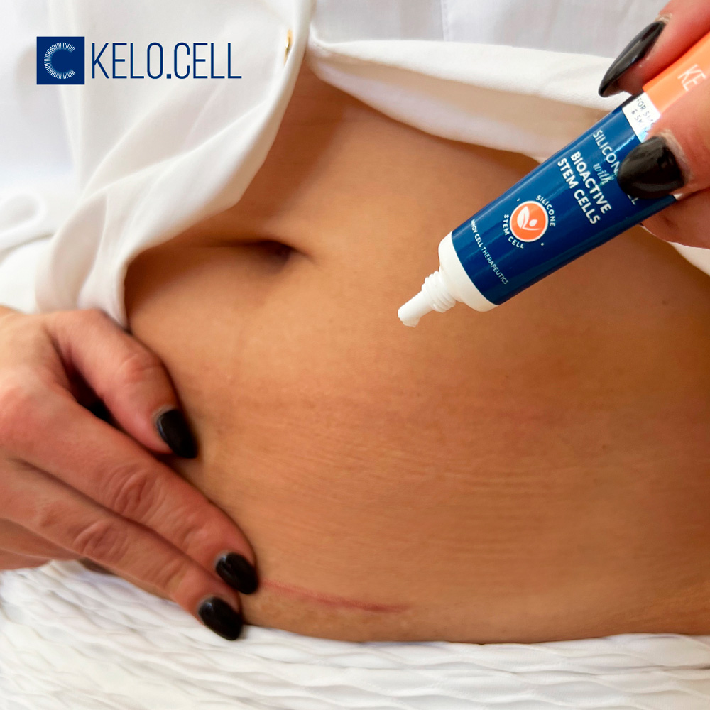 Kelo-cote Advanced Formula Scar Gel, Improves The Appearance Of Scars, 10 Grams - View #10